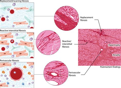 Towards Better Definition Quantification And Treatment Of Fibrosis In