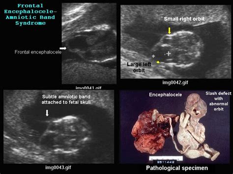 Ultrasound Of Cleft Lip And Palate