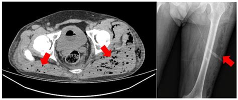 Figure 1 Bilateral Gluteal Purulent Collection With Necrotizing