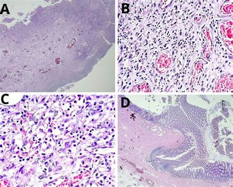 Intususcepción sigmoidea secundaria a pólipo fibroso inflamatorio Caso