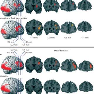 Significant Increases In Regional Cerebral Blood Flow Rcbf During A