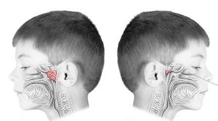 Amigdalite E Adenóide - Cirurgia das Amígdalas e Adenóide: Tudo o que Você Precisa Saber - Dr ...