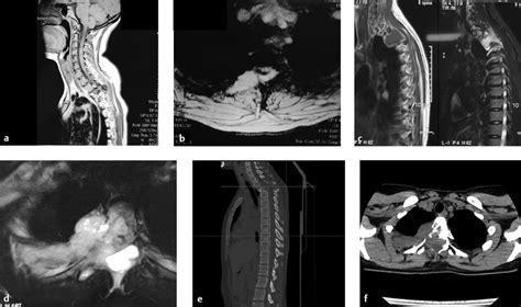 16 The Role Of Navigation In The Resection Of Primary Spinal Tumor