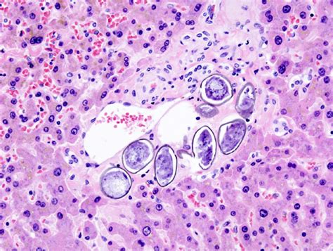 Infection Landscapes Schistosomiasis