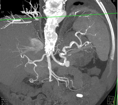 Splenic Artery Aneurysm Spleen Case Studies Ctisus Ct Scanning