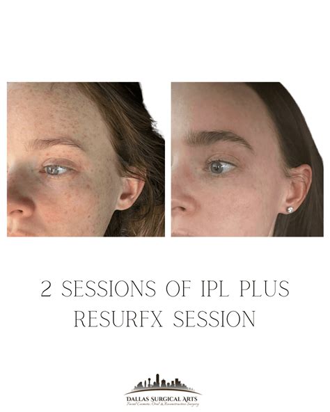 M Ipl Resurfx