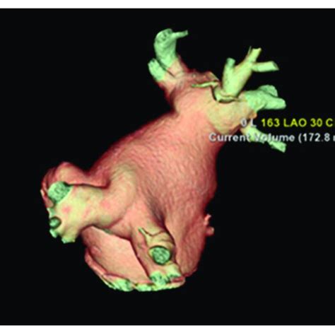 Cardiac Ct 3d Reconstruction Of The Left Atrium Posterolateral