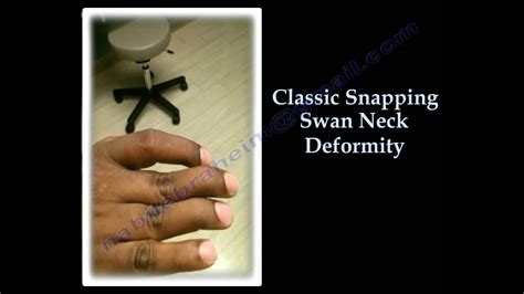 Swan Neck Deformity Classic Snapping Everything You Need To Know Dr Nabil Ebraheim Youtube