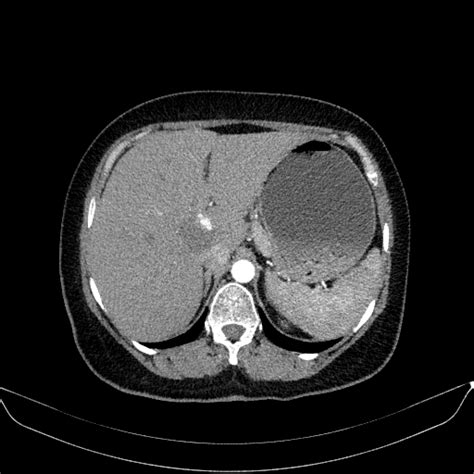 Hepatic Hemangioma Image