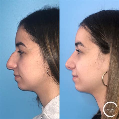 Collection 94 Pictures Before And After Pictures Of Nose Jobs Stunning