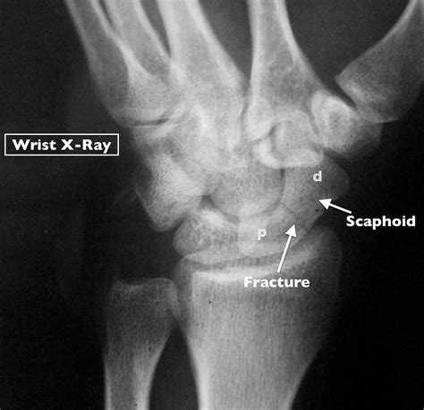 Physio Network On Twitter 8 Scaphoid Fractures Are Notorious For