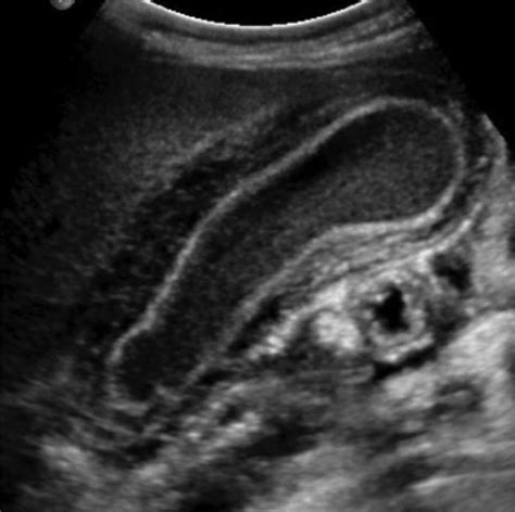 Acute Acalculous Cholecystitis Applied Radiology