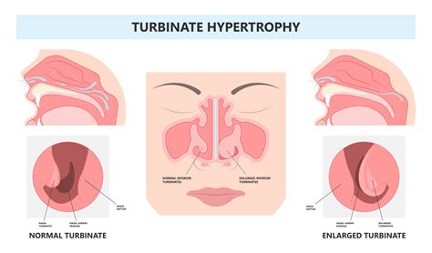 Inferior Turbinate Hypertrophy | Aglow ENT Centre