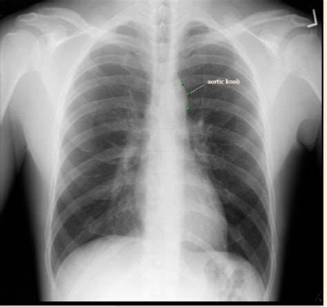 Radiography Chest Anatomy Flashcards Quizlet