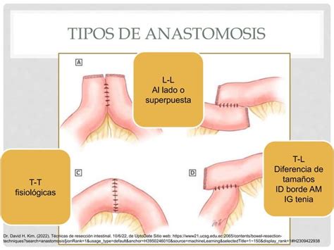 ANASTOMOSIS INTESTINALES Pptx