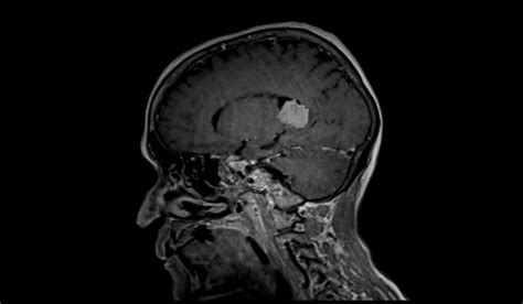 Choroid Plexus Papilloma (CPP) MRI | Radiology Article on Choroid ...