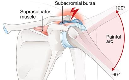 Front Shoulder Pain: Causes & Treatment For Anterior Shoulder Pain