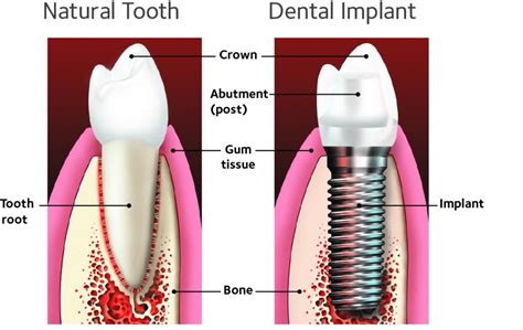 Aspen Dental Implants - Dental News Network