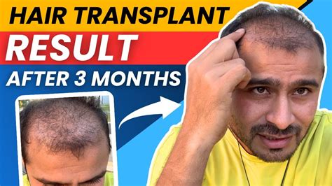 Showing My 3 Months Hair Transplant Result Timeline Best Hair