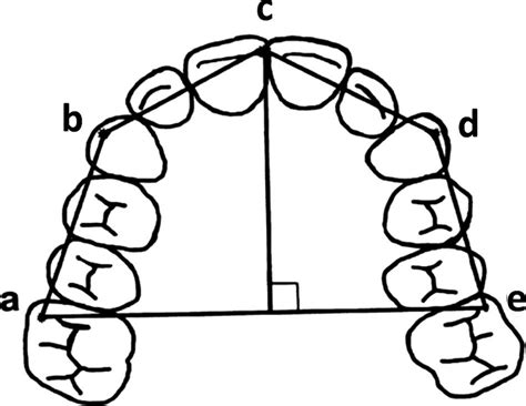 Maxillary Arch Dimensions Arch Width Distance Between The