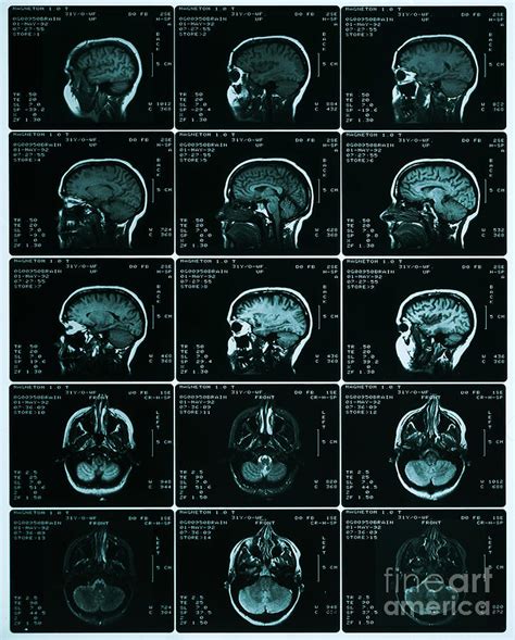 Mri Of Normal Brain Photograph By Science Source Pixels