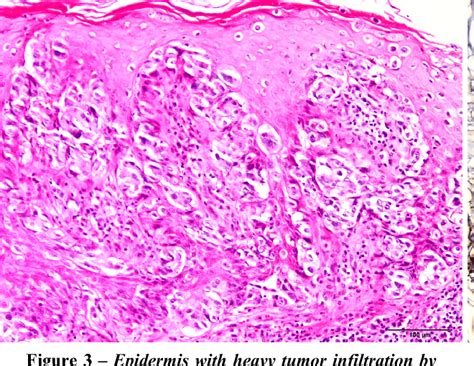 Figure 2 From Extramammary Paget ’ S Disease In An Hiv Positive Patient Constantin Semantic