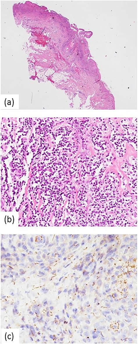 Treponemal infection in perianal skin. (a) Biopsied skin specimen (H ...