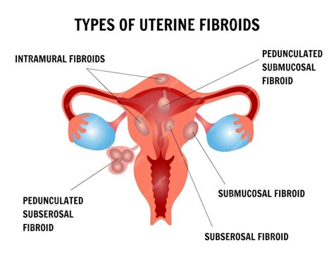 Premium Vector Infographic Of Types Ofuterine Fibroids In Vector