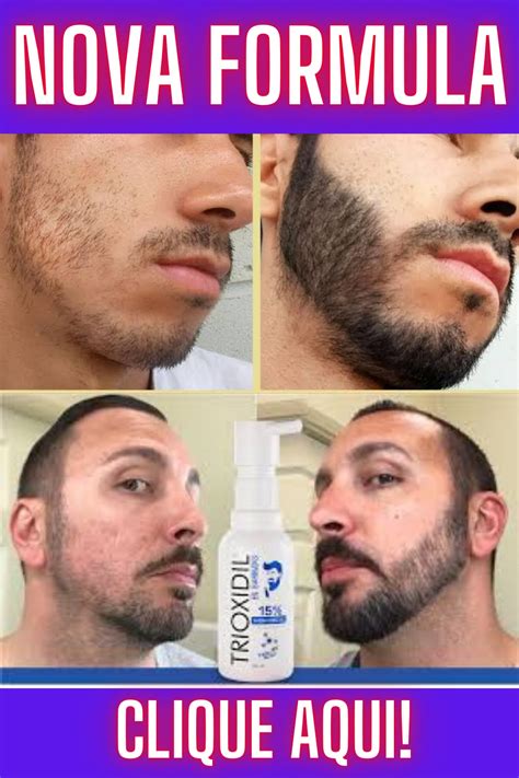 VEJA COMO FAZER SUA BARBA CRESCER USANDO A NOVA FÓRMULA DE MINOXIDIL