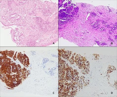 The Significance Of Co Mutations In EGFR Mutated Non Small Cell Lung