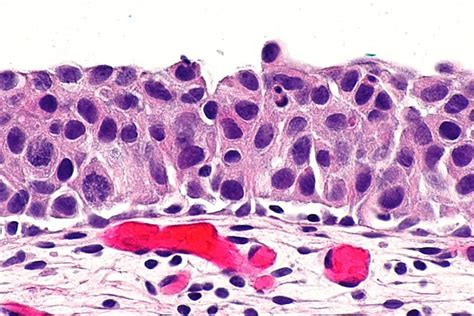 Urothelial Carcinoma In Situ Libre Pathology