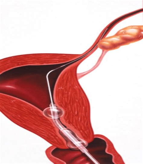 Blocked Fallopian Tubes Heres How We Can Help