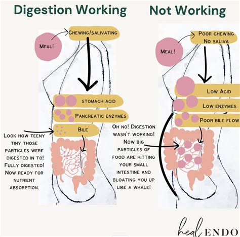 What Is Endo Belly Endometriosis Bloat Digestive Disfunction — Heal Endo