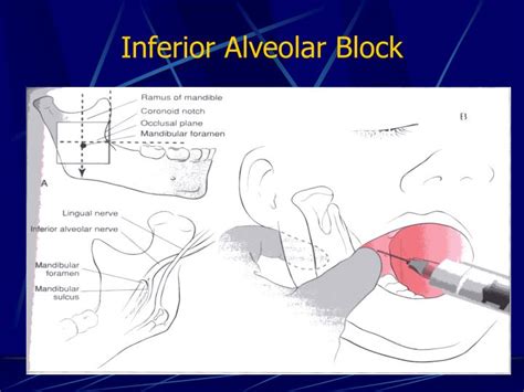 Ppt Nerve Blocks Powerpoint Presentation Id 6088129