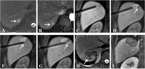 A 62 Year Old Male With A 0 9 Cm Hcc Lesion Located In Segment Viii Download Scientific