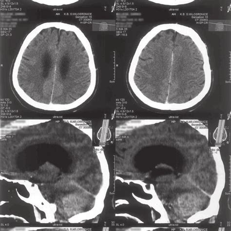 Computed Tomography Scan Of The Brain Axial Slice Contrast Enhanced