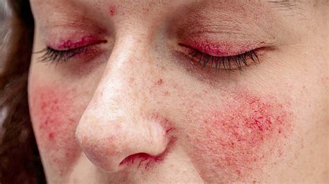 Lupus Rash Vs Rosacea Symptoms Causes Treatments