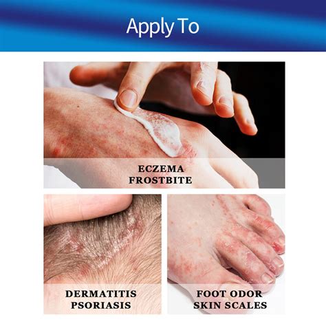eczema treatment cream psoriasis ointment skin dermatitis fungus anti