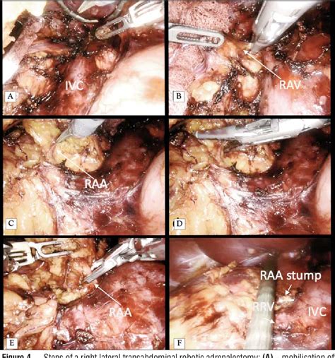 Figure 1 From Minimally Invasive Adrenalectomy Technical Aspects Of