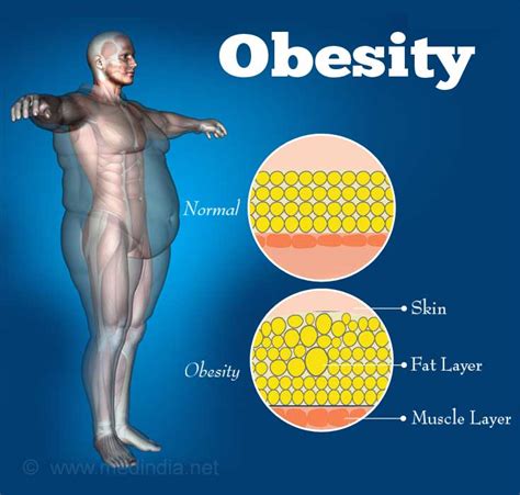 Obesity Causes Symptoms Diagnosis Complications Treatment