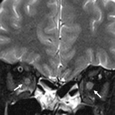 Figure MRI Of The Present Patient With Neuromyelitis Optica Spectrum