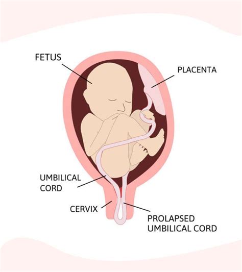 What Is Umbilical Cord Prolapse Its Causes And Tips To Manage