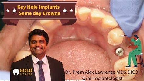 Same Day Dental Implants Teeth Key Hole Implants Best Implant