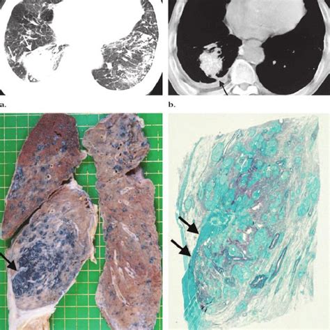 Ct Scans And Autopsy Findings In A Year Old Man With Silicosis