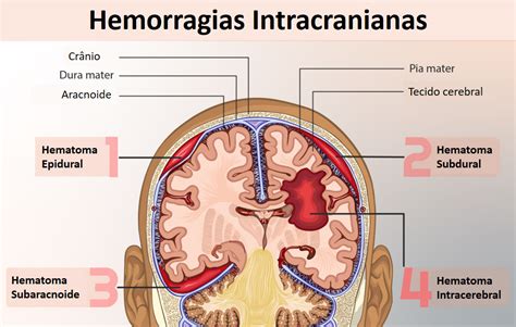 Hemorragias Intracranianas Tipos Fatores De Risco E Sintomas The Best