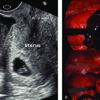 A Sonographic Feature Of Normal Intrauterine Pregnancy Of Heterotopic