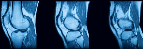 Mri Knee Cartilage Damage