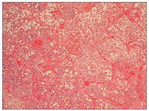 Community Acquired Pneumonia Thoracic Key