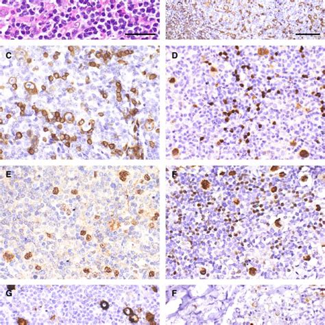 Immunohistochemical Features Of An Epstein Barr Virus Positive Nodular