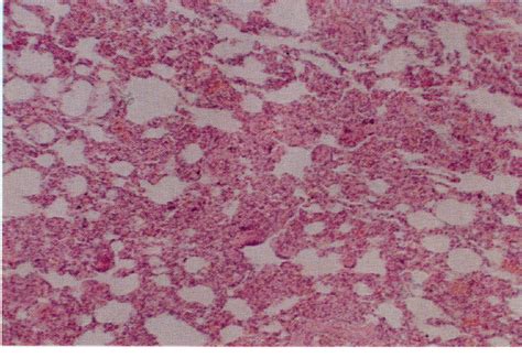 Figure 4 From Pulmonary Air Embolism Reappraisal Of The Importance In